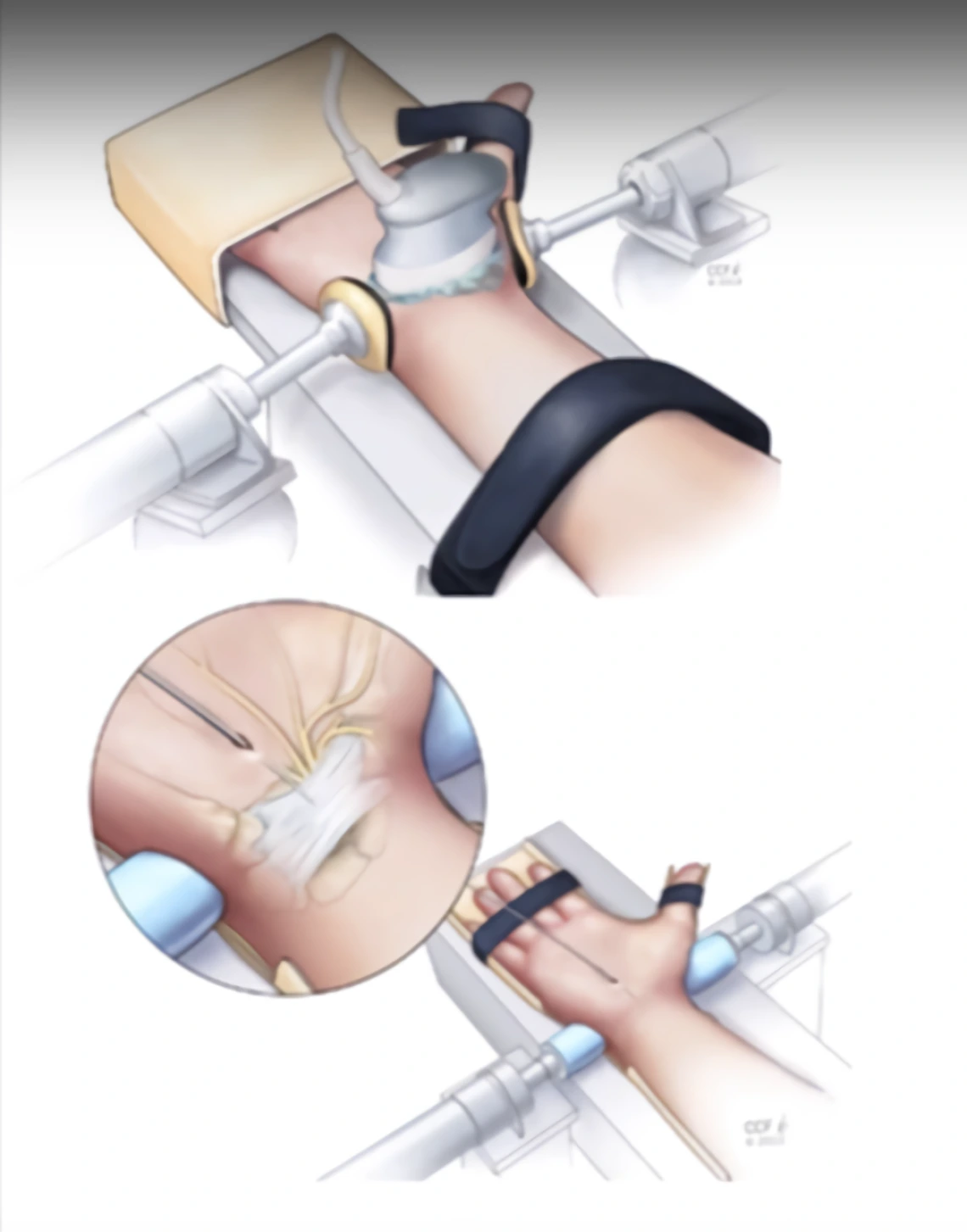 carpal tunnel diagram