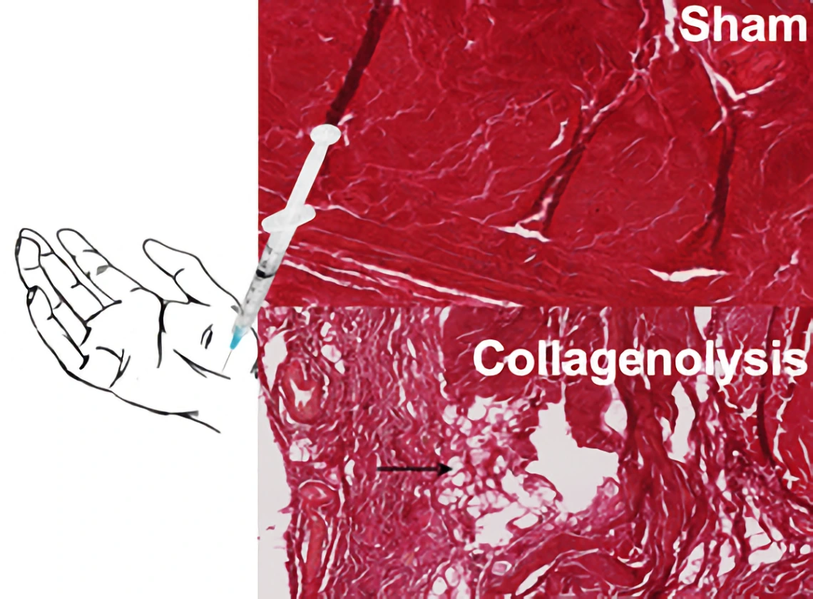 collagenloysis diagram